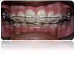 Pic Clear Braces